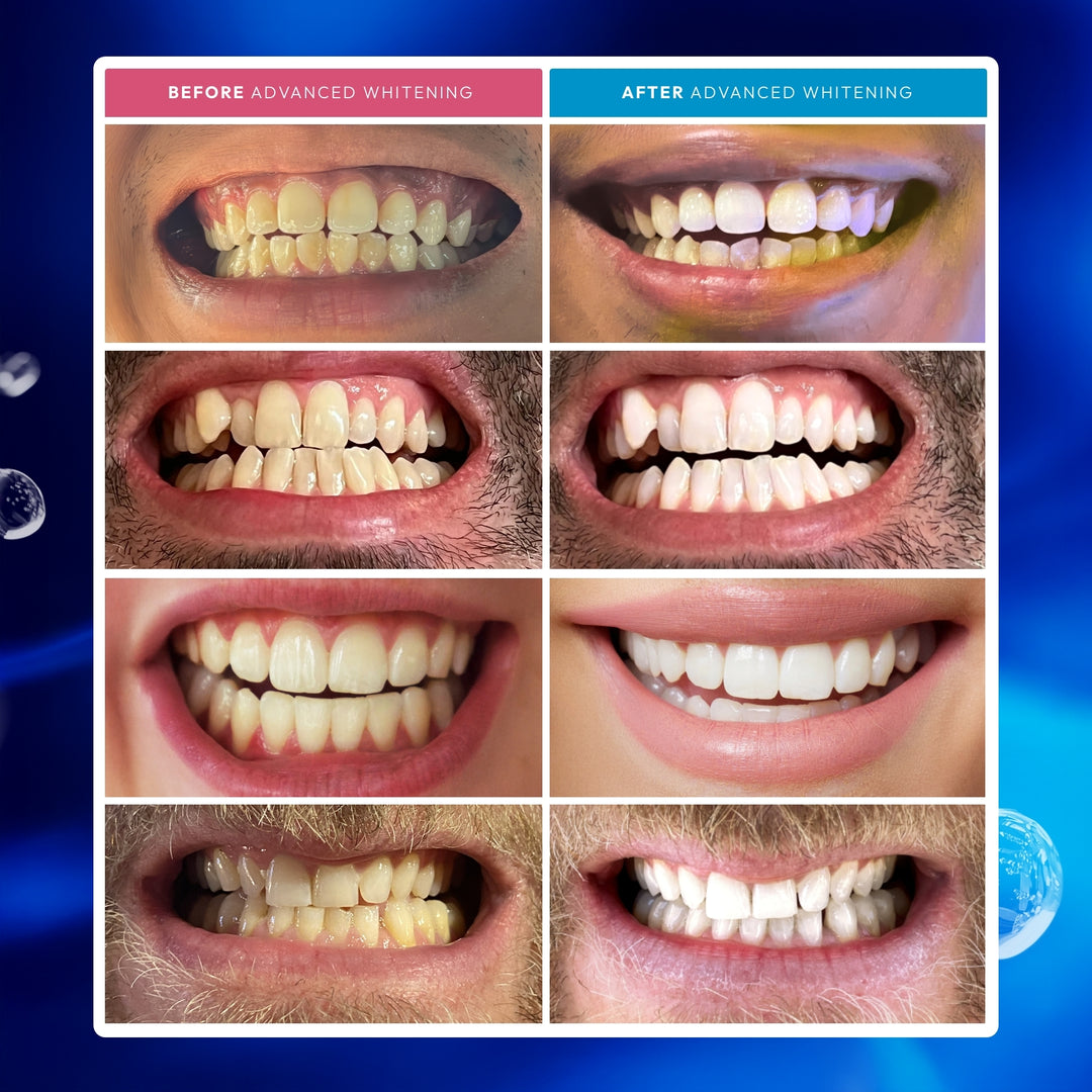 Advanced Teeth Whitening Kit