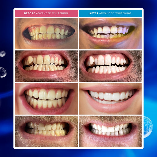 Advanced Teeth Whitening Kit